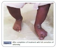 We did not find results for: Cross Sectional Study Of Clinical Profile And Treatment Of Clubfoot By Ponseti Method Among Infants At A Tertiary Care Hospital Insight Medical Publishing