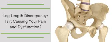 Image result for Functional Leg Length Discrepancy