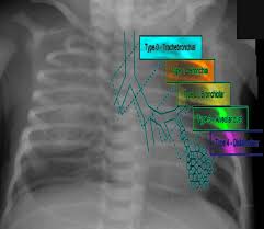 Cpam integrated with cucm for remote facility lockdown and lockdown reset. Figure Types Of Cpam Image Courtesy S Bhimji Statpearls Ncbi Bookshelf
