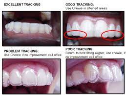 Invisalign Aligners | Check Your Fit | Morita Orthodontics