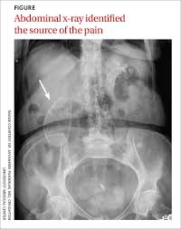 A complete abdominal ultrasound examines those three organs and adds the: Recurrent Right Upper Quadrant Abdominal Pain Mdedge Family Medicine