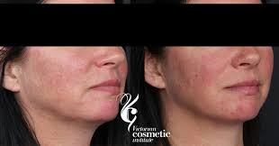 Ultherapy works differently to conventional lasers that target the outer layers on the skin. Ulthera Or Ultherapy For Skin Tightening And Lifting