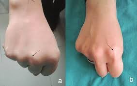 If your finger becomes dislocated, you should avoid manipulating it. In Flexion A Ulnar Dislocation Of The Extensor Tendon Of The Long Download Scientific Diagram