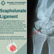Image result for Scapholunate Dislocation