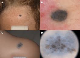 Image result for Blue Nevus