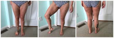 Preventive Mastectomy Fat Grafting Week 2 Prairiewifeinheels Com
