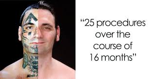 At vamoose, we've completed over 10,000 tattoo removal sessions. I Was Totally Prepared To Douse My Face In Acid Ex Skinhead Gets His Racist Tattoos Removed After Becoming A Dad Bored Panda