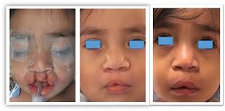 Patient (Control group) with bilateral cleft lip, with preop and 3 & 6...