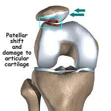 Chondromalacia Patella - Dr. Mukhi's Raj Hospital