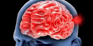 As pontadas na cabeça são problemas que acometem muitas pessoas. Instituto Do Cerebro E Coluna Maraba A Hipertensao Pode Causar Um Aneurisma Cerebral