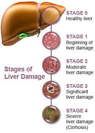 Stages Of Liver Failure Liver Healthy Detox Cleanse Healthy Liver Detox Your Liver