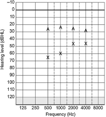 abutment free bone anchored hearing devices in children