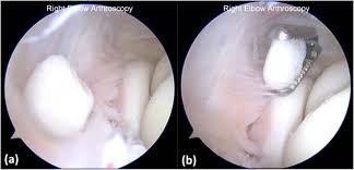 Typical knee liposuction recovery time is about a month, sometimes it can take longer. Loose Bodies Of The Elbow Joint Cancer Therapy Advisor
