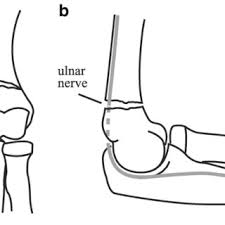 Supracondylar fractures are classified into 3 main types based on the gartland system (can be either extension or flexion type) Pdf Beware Of Ulnar Nerve Entrapment In Flexion Type Supracondylar Humerus Fractures
