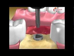 Gio dental implant (tanam gigi). Myhealth Implan Gigi Youtube