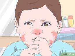 Image result for Allergic Colitis of Infancy