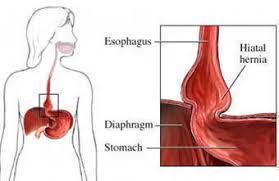 Maybe you would like to learn more about one of these? Hiatal Hernia Www Headbacktohealth Com