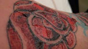 Mild infections can be treated within two weeks, while more severe cases may require several months of antibiotic treatment, says dr. Tattoo Infection Symptoms And Treatment