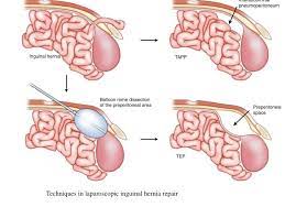 Hernia Repair - General And Hepato-Pancreato-Biliary Surgeon