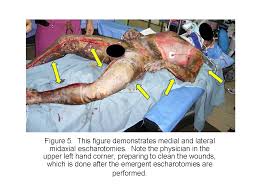 Neck escharotomy should be done laterally and posteriorly to avoid the carotid and jugular vessels. 5 Escharotomy Wheeless Textbook Of Orthopaedics