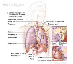 Once the cancer has spread to the liver, the prognosis and survival rate from the disease can drop significantly. Lung Cancer Staging Rocky Mountain Cancer Centers