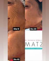 SEGUIMIENTO DE RITIDEZ Excelentes cambios en pocos días. Agenda cita al  WhatsApp 4921345962