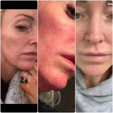 Is anyone still in the stages of seeing if lupus is the diagnosis? I just  don't want it to be but wants to know of the causes of this pain and other