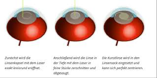 Bis die wundheilung abgeschlossen ist, muss drücken und reiben am operierten auge unbedingt vermieden werden. Neu Operation Mit Laser Augenklinik Saar Sulzbach