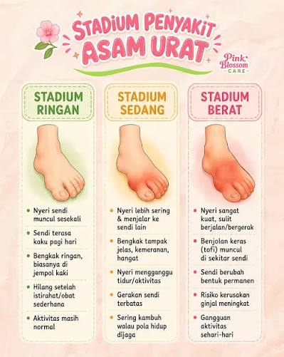 Munculnya Tofi di area tubuh. Masih muda tapi sendi udah ngilu? Jangan disepelein, bisa jadi asam urat!” Bukan cuma karena umur, tapi karena gaya hidup. Yuk mulai jaga pola makan, banyak gerak, dan kurangi jajan tinggi