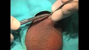 La vasectomía sin bisturí es un procedimiento quirugíco menor, utilizado por los cirujanos para esterilizar a los hombres. Vasectomia Sin Bisturi Youtube