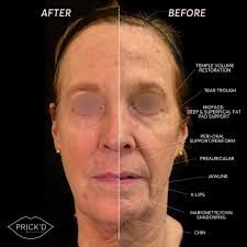 Full Facial Balancing is one of our signature treatments ⚖️ A customized  blend of filler and neuromodulator (Botox, Daxxify, etc.) designed to  restore youthfulness, structure, and harmony exactly where YOU need it!!!
