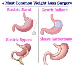 4 most mon weight loss surgery in