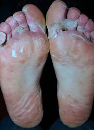 7) «coxsackievirus a6 associated hand, foot and mouth disease in adults: Scarlet Fever Like Outcomes Of Hand Foot And Mouth Disease European Journal Of Pediatric Dermatology
