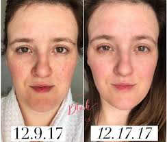 Ouch!!! Sunburn hurts a lot