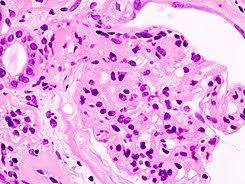 Resultado de imagen de sindrome nefrotico