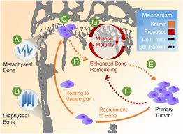 Cancer that has spread to the brain can cause different symptoms depending on where in the brain is affected. Multiscale Characterization Of The Mineral Phase At Skeletal Sites Of Breast Cancer Metastasis Pnas