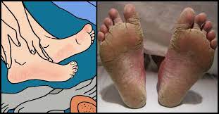 Dryness is one of them. 7 Alarming Reasons You Have Peeling Or Cracked Feet Littlethings Com