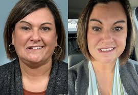The treatments considered for bell's palsy include oral corticosteroids (prednisolone) and antiviral drugs. Surgical Technique Is A Game Changer For Patients With Bell S Palsy Consult Qd