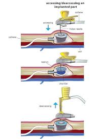 Central Venous Access Devices Oncology Nursing Nurse Fluid And Electrolytes