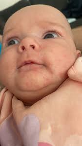 Hi first time mam wondering if this rash is just milk spots?