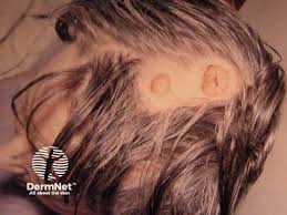 Image result for Tertiary Syphilis