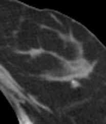 When the doctor knows this, they can choose the best course of treatment and maybe even predict your chances of recovery. Breast Lesions Incidentally Detected With Ct What The General Radiologist Needs To Know Radiographics