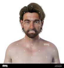 Image result for Anhidrosis