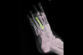 Image result for Metatarsal