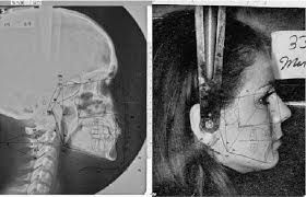 A sample of a digitized lateral cephalogram head film and a facial...