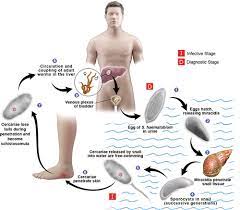 Genitourinary Schistosomiasis Life Cycle And Radiologic Pathologic Findings Radiographics