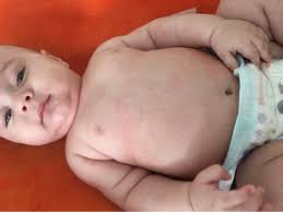 However, doctors are telling parents that a nightly bath is unnecessary, and for some children, it may even be detrimental to their skin health. Bath Every Night Causing Rash October 2015 Babies Forums What To Expect