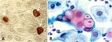 Image result for Chlamydia Trachomatis