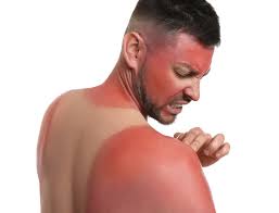Image result for Sunburn