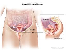 Because it is cancer, it affects surrounding organs and keeps on spreading. Cervical Cancer Treatment Mhealth Org